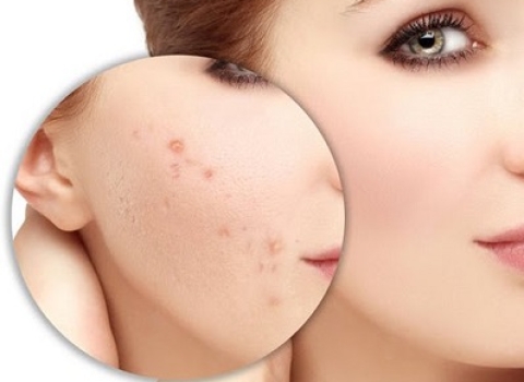 5 nguyên tắc khi điều trị thâm mụn