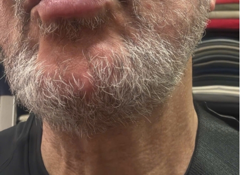 What to Do If You Have Fluid-filled Blisters on Your Lips While Visiting Da Nang