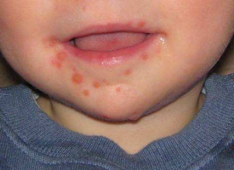 Hand, Foot, and Mouth Disease (HFMD)