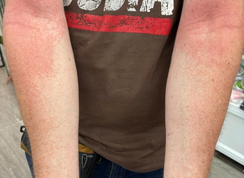 What Should I Do About an Itchy Skin Rash in Hoi An?