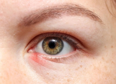 Red Bump on a Child’s Eyelid While Traveling in Nha Trang: What Parents Should Do