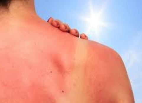How to treat sunburn when you in Hoi An, let come to ABC Pharmacy