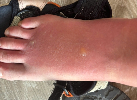 How to Treat Sunburn on Feet While Traveling in Vietnam: A Practical Guide for Tourists