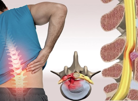 5 Common Causes of Herniated Disc Everyone Should Know