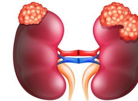 2 Nhóm Người Dễ Mắc Ung Thu Thận Nhất!!