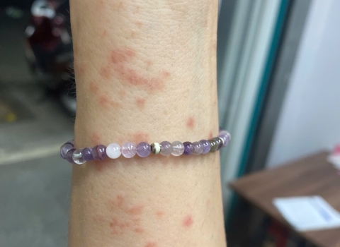 Jellyfish Sting Rash in Da Nang | ABC Pharmacy