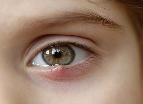Interesting experience of a male customer with a stye at ABC Hoi An pharmacy
