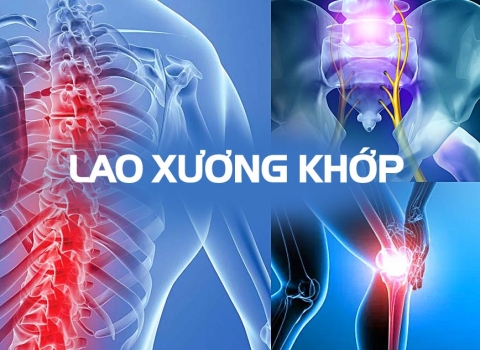 Bệnh lao xương: Nguyên nhân, triệu chứng và cách điều trị