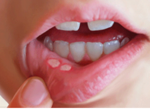Medicines to treat mouth ulcers are often used in Vietnam.