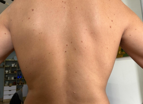 Mole Removal in Da Nang: Surgical Excision vs CO₂ Laser