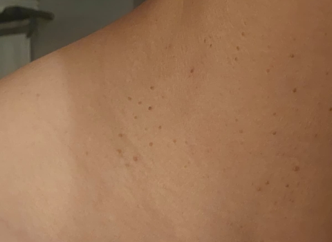 Skin Tag Removal in Da Nang