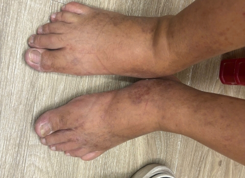 Swollen Foot After a Flight in Da Nang: When Travelers Should Be Concerned