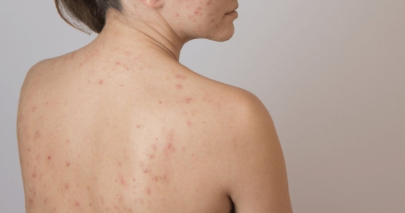 Tìm hiểu về mụn lưng