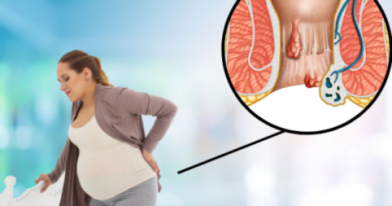 phụ nữ mang thai rất dễ bị trĩ và điều trị thế nào cho hiệu quả?