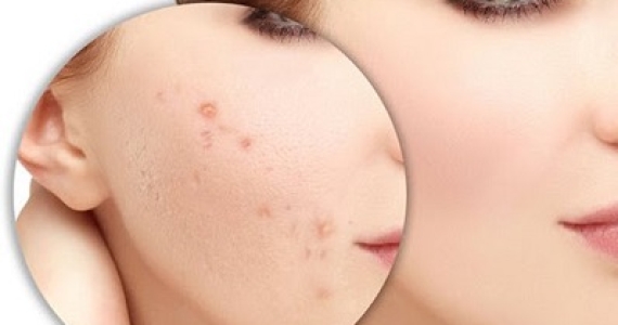5 nguyên tắc khi điều trị thâm mụn