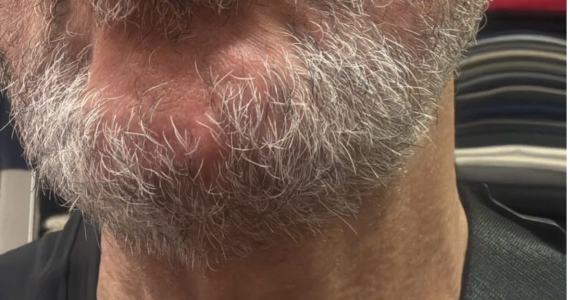 What to Do If You Have Fluid-filled Blisters on Your Lips While Visiting Da Nang