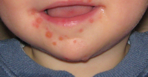 Hand, Foot, and Mouth Disease (HFMD)