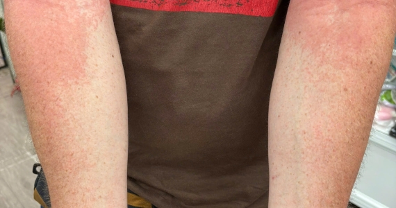 What Should I Do About an Itchy Skin Rash in Hoi An?