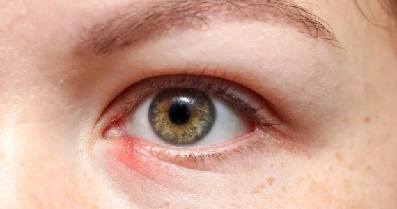 Red Bump on a Child’s Eyelid While Traveling in Nha Trang: What Parents Should Do
