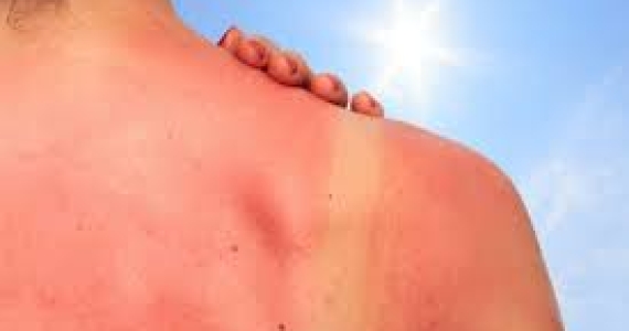 How to treat sunburn when you in Hoi An, let come to ABC Pharmacy