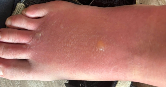 How to Treat Sunburn on Feet While Traveling in Vietnam: A Practical Guide for Tourists