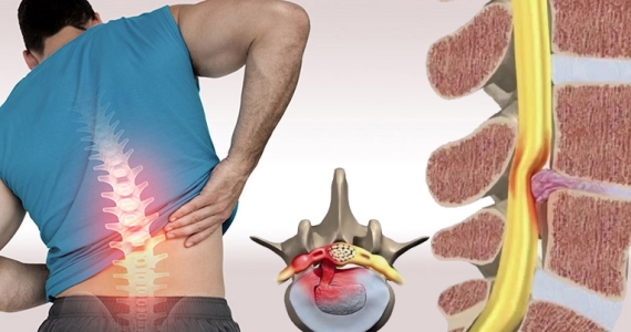 5 Common Causes of Herniated Disc Everyone Should Know