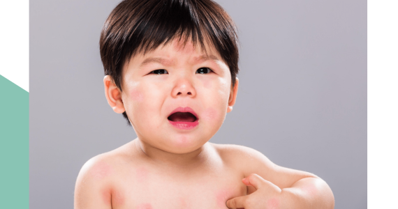 Tại Sao Trẻ Ăn Hải Sản Bị Ngứa? Đây Là Cách Chữa Trị