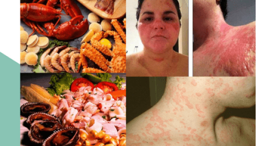 Tôi ăn hải sản bị nổi mề đay - Nguyên nhân và cách điều trị
