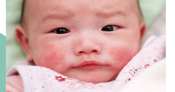 Biểu Hiện Của Dị Ứng Hải Sản Ở Trẻ Sơ Sinh Cha Mẹ Phải Biết