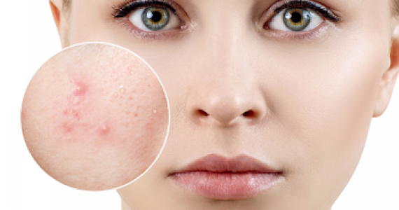 Tìm Hiểu Về Mụn Bọc Và Các Điều Trị Mụn Bọc