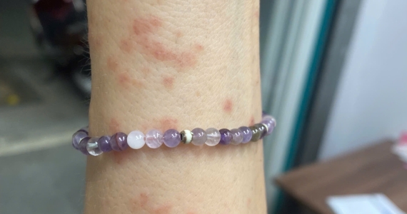 Jellyfish Sting Rash in Da Nang | ABC Pharmacy