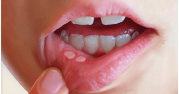 Medicines to treat mouth ulcers are often used in Vietnam.