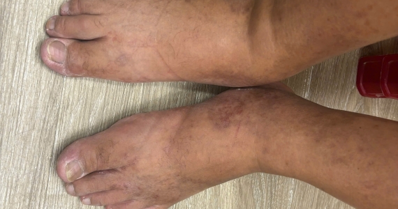 Swollen Foot After a Flight in Da Nang: When Travelers Should Be Concerned