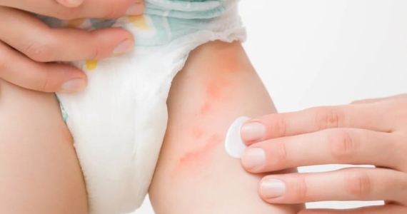 Trẻ Bị Hăm Tã Phải Làm Gì? Nguyên Nhân Và Cách Trị Hăm An Toàn, Hiệu Quả | ABC Pharmacy