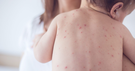 Trẻ Em Bị Sốt Xuất Huyết Có Nguy Hiểm không? Triệu Chứng Và Cách Điều Trị | ABC Pharmacy