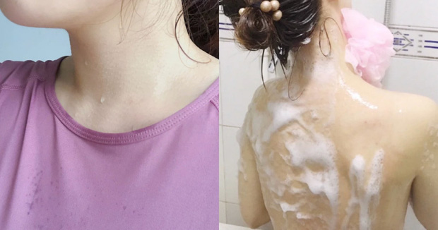 Cach-khac-ơhuc-mun-lung-abcpharmacy-danang