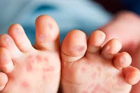 Hand_Foot_Mouth_Disease abc pharmacy da nang