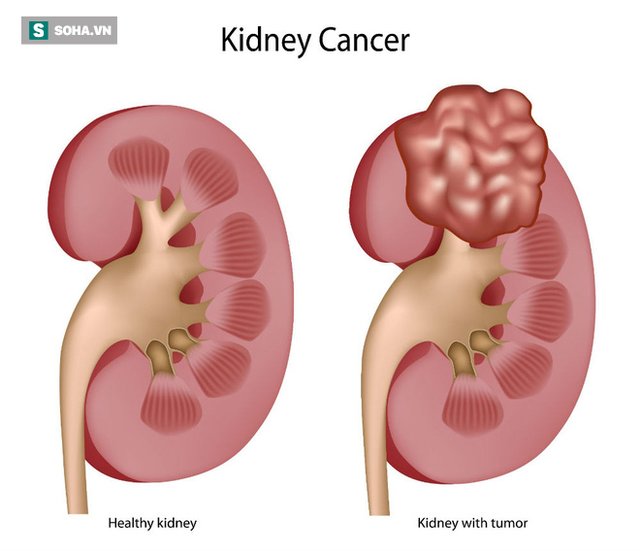 Ung-Thu-Than-abc pharmacy danang