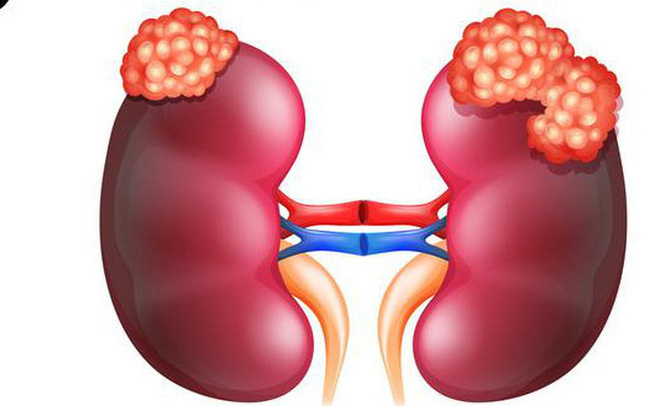 Ung-Thu-Than-abc pharmacy danang