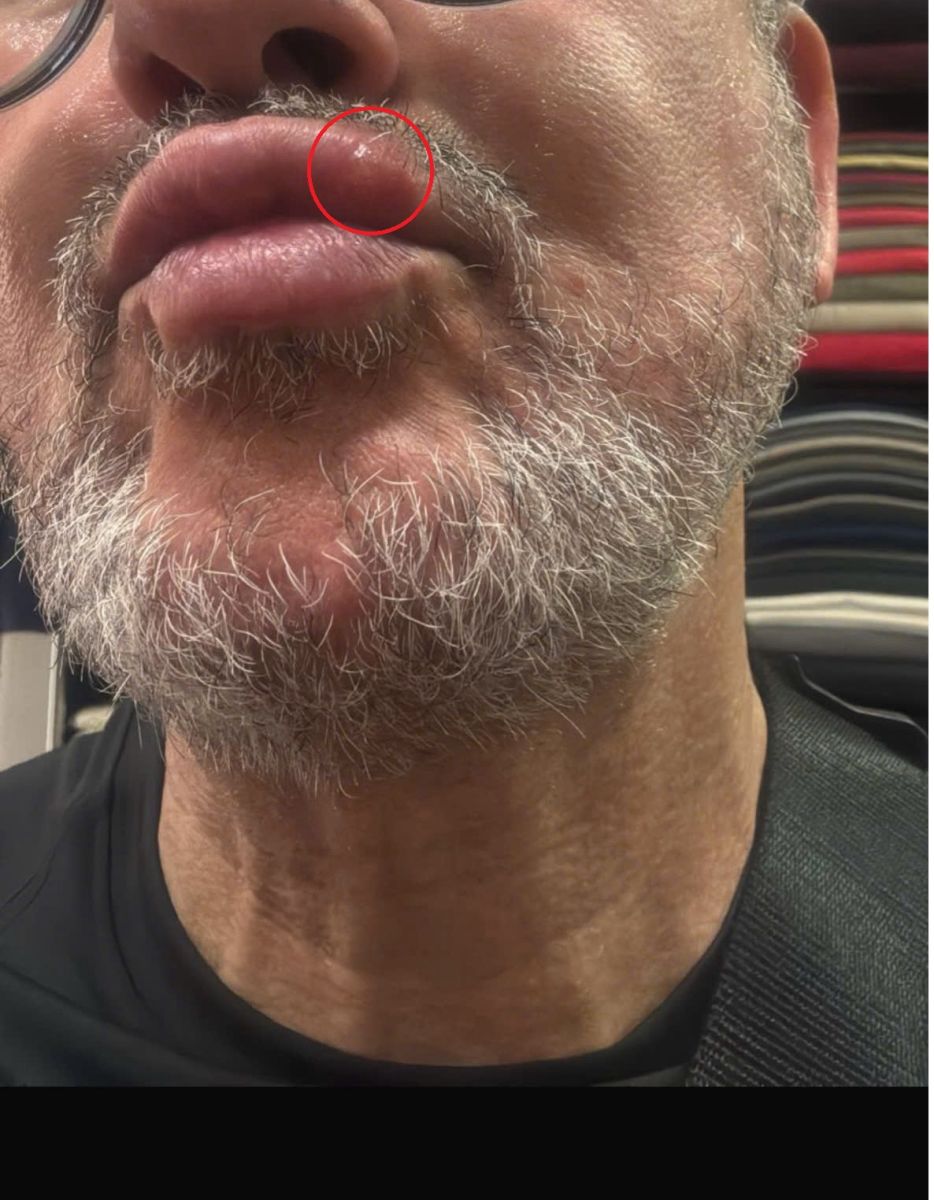 fluid-filled blisters on your lips while traveling in Da Nang