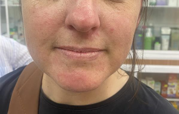 Facial redness while traveling in Da Nang