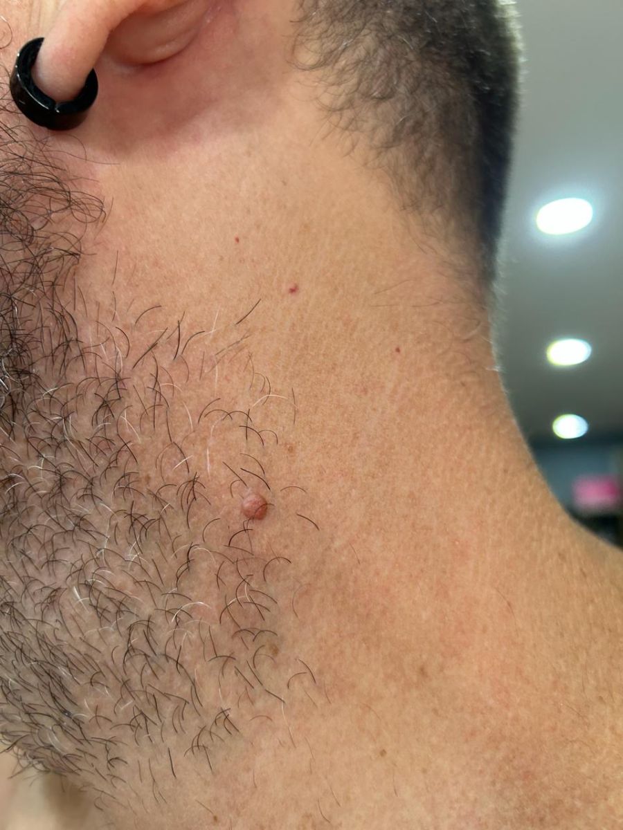 Close-up of a raised skin lesion on the neck before dermatologist assessment for possible mole removal at ABC Dermatology Clinic in Da Nang