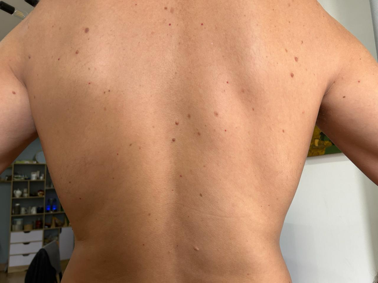 Back with multiple pigmented skin lesions before dermatologist assessment at ABC Dermatology Clinic in Da Nang