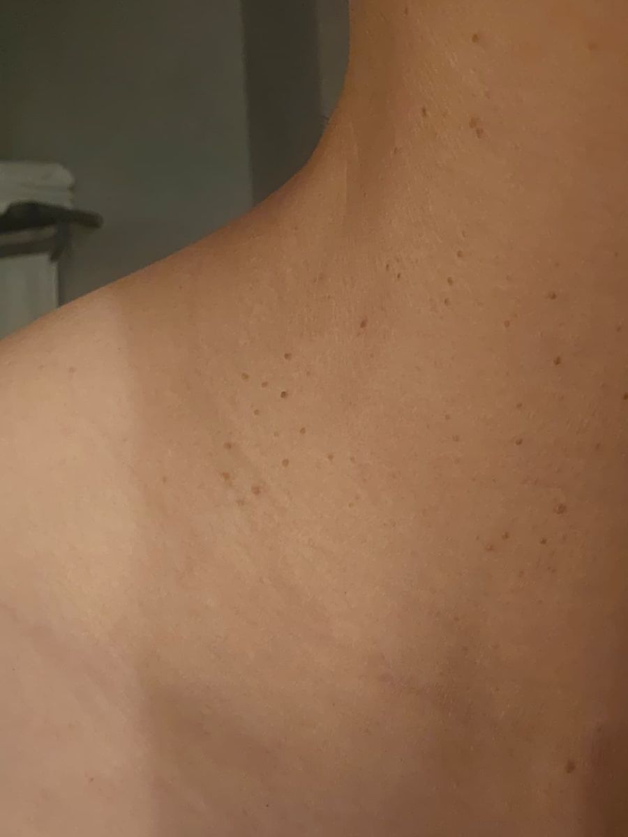Skin tag removal consultation at ABC Dermatology Clinic in Da Nang