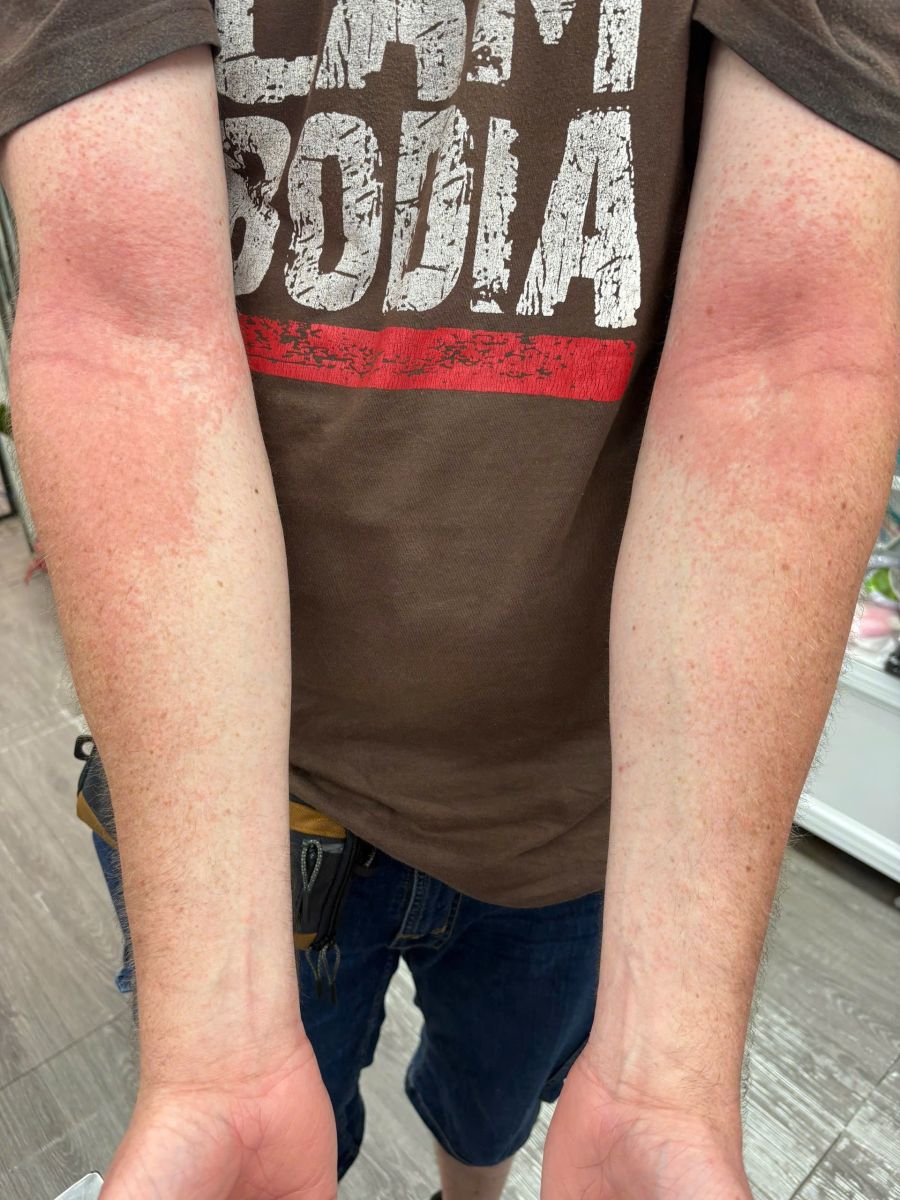 Itchy Skin Rash in Hoi An