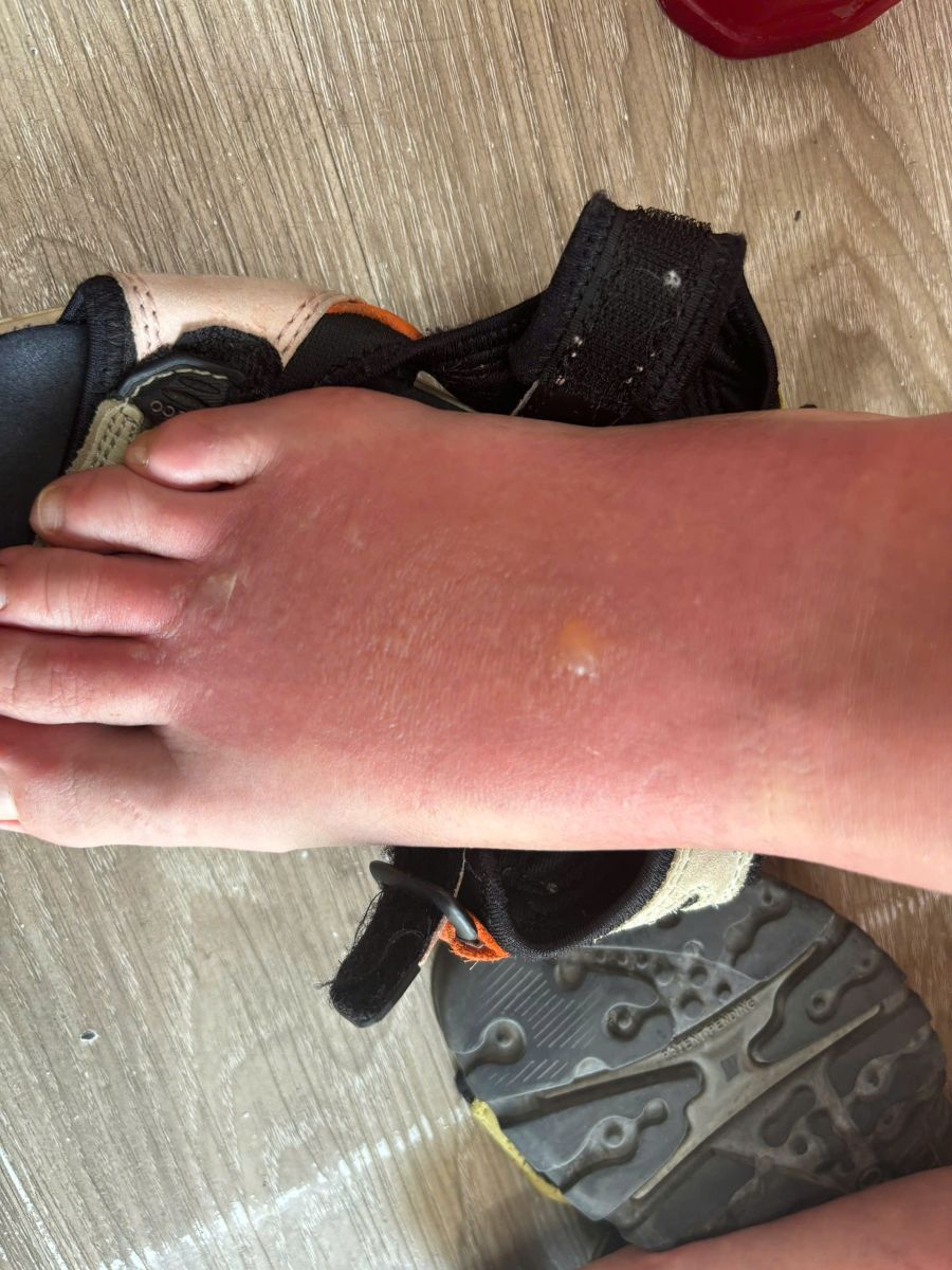 How to Treat Sunburn on Feet
