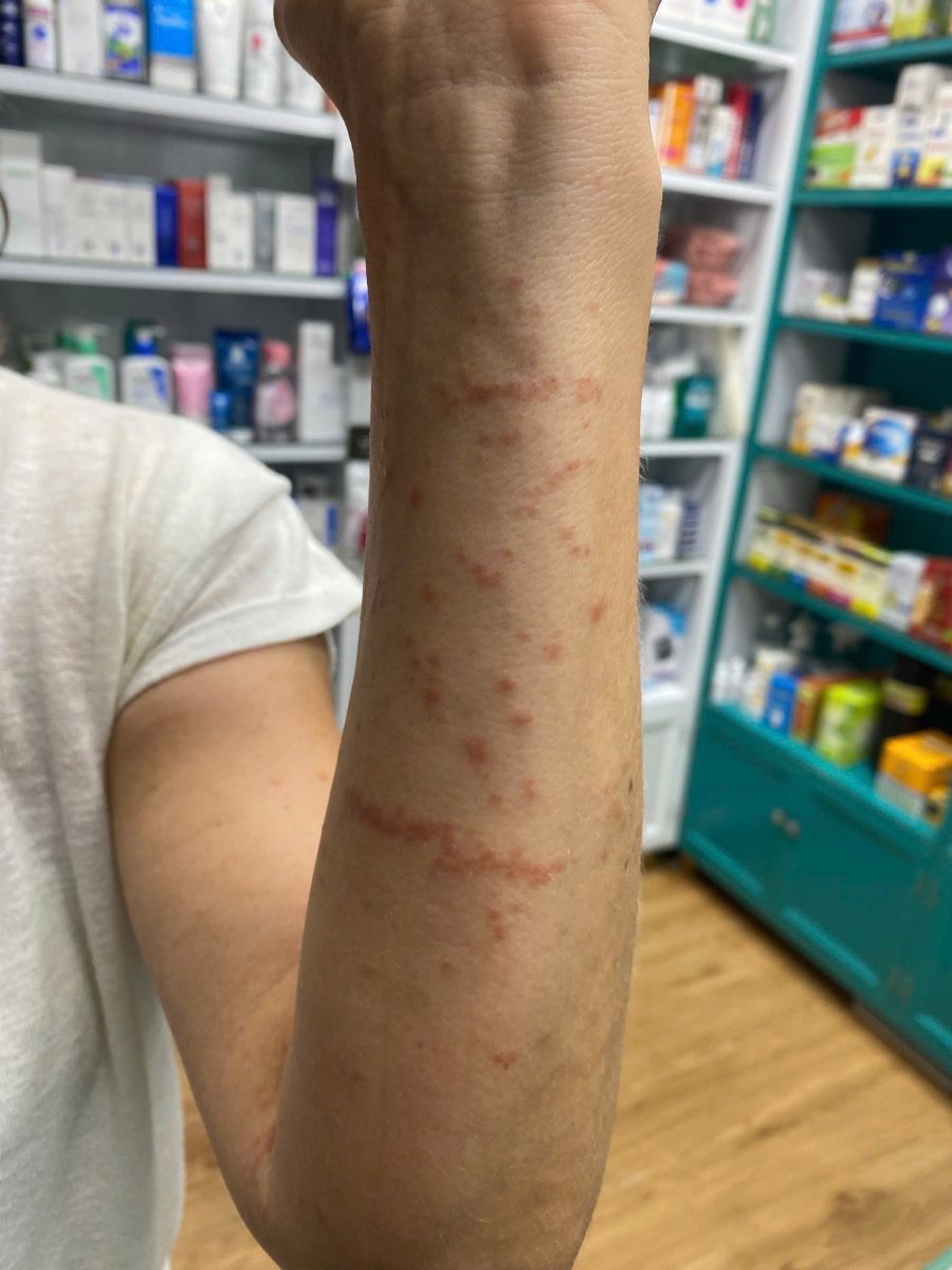 Linear red itchy rash on the forearm after jellyfish contact at a Da Nang beach