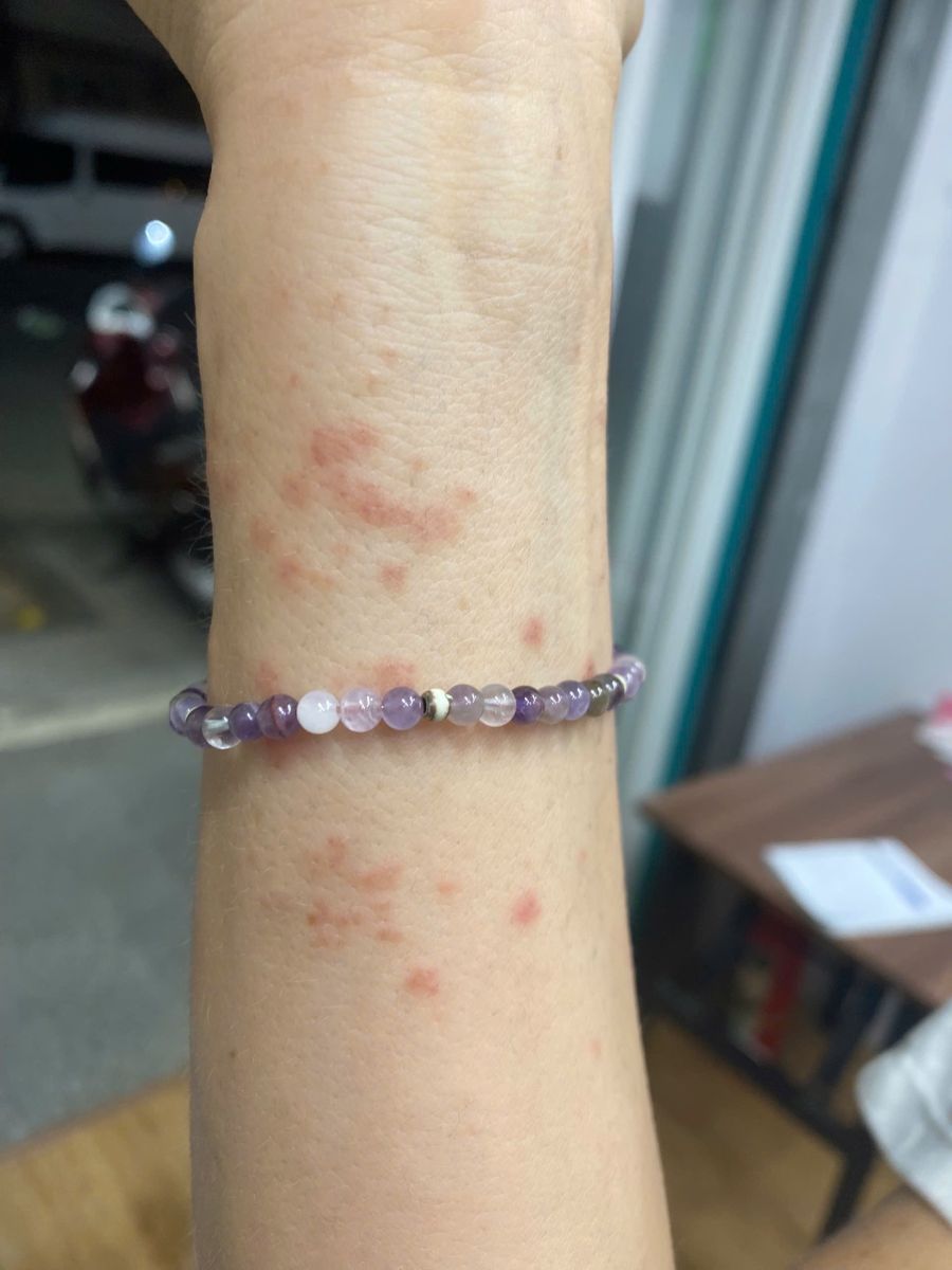 Itchy red jellyfish sting rash on the wrist after swimming in Da Nang