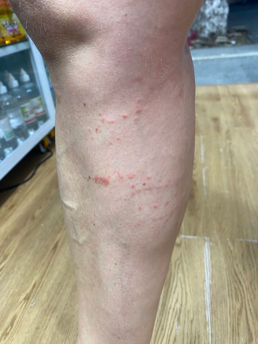 Red itchy welts on the leg after possible jellyfish or sea creature sting in Da Nang