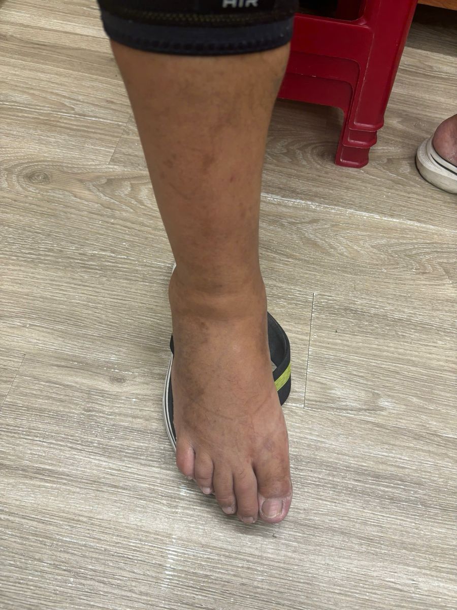 One-sided swelling of the right foot and ankle in an adult traveler after walking and recent air travel in Da Nang